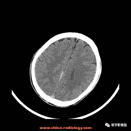 【病例】一氧化碳中毒1例CT影像表现 【病例】一氧化碳中毒1例CT影像表现