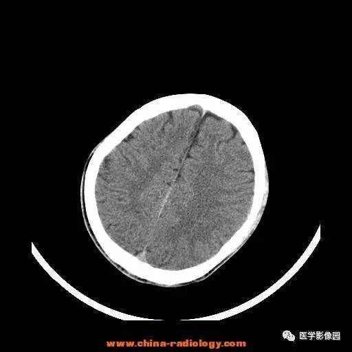 【病例】一氧化碳中毒1例CT影像表现 【病例】一氧化碳中毒1例CT影像表现