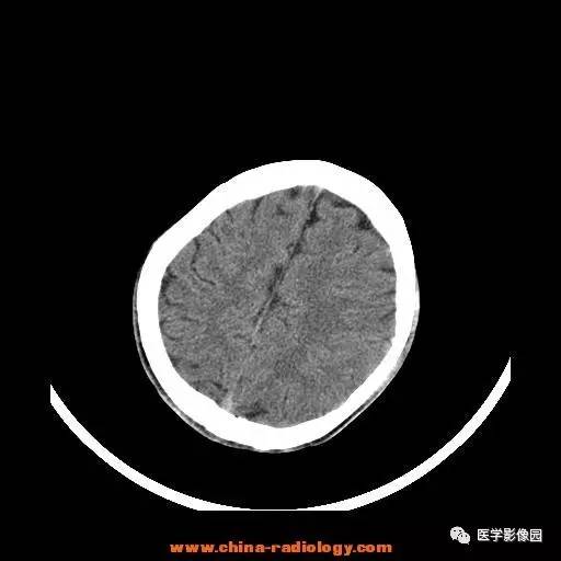 【病例】一氧化碳中毒1例CT影像表现 【病例】一氧化碳中毒1例CT影像表现