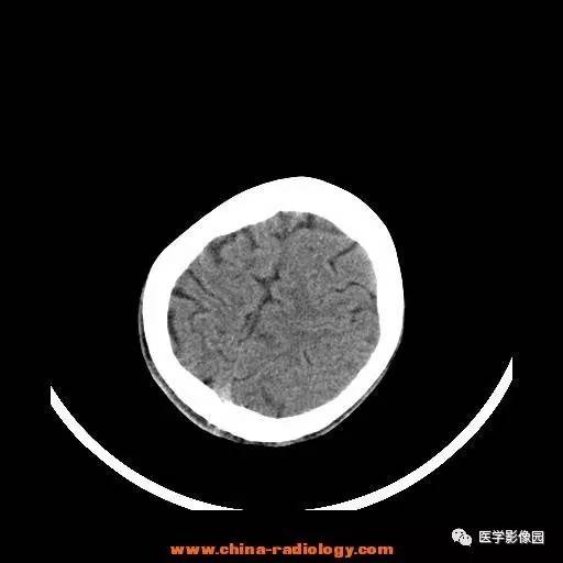 【病例】一氧化碳中毒1例CT影像表现 【病例】一氧化碳中毒1例CT影像表现