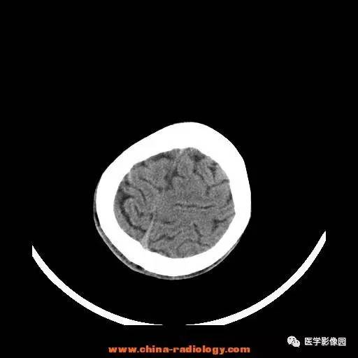 【病例】一氧化碳中毒1例CT影像表现 【病例】一氧化碳中毒1例CT影像表现