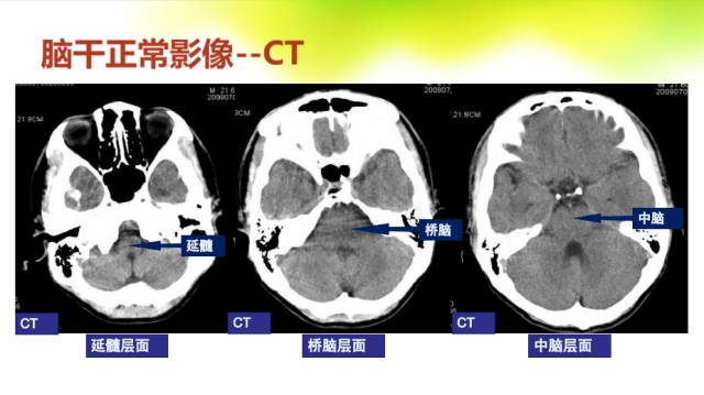 【PPT】脑干影像解剖及诊断