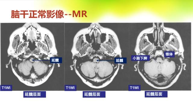 【PPT】脑干影像解剖及诊断
