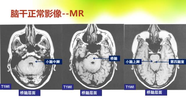 【PPT】脑干影像解剖及诊断