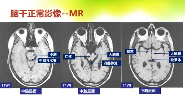 【PPT】脑干影像解剖及诊断