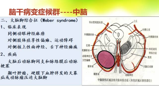 【PPT】脑干影像解剖及诊断