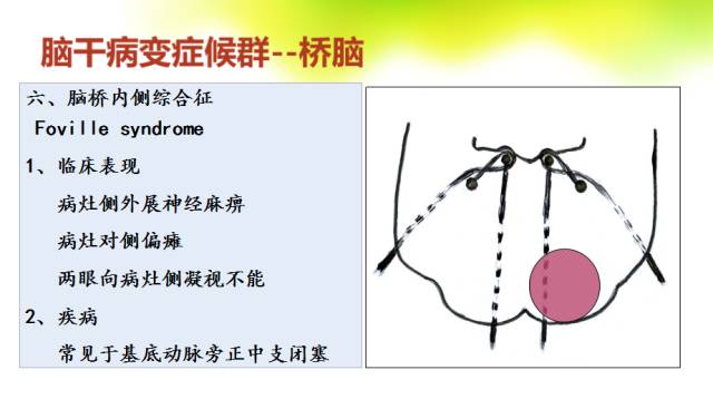 【PPT】脑干影像解剖及诊断