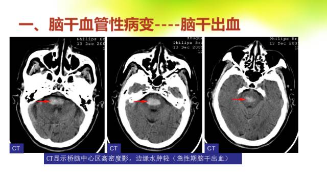 【PPT】脑干影像解剖及诊断