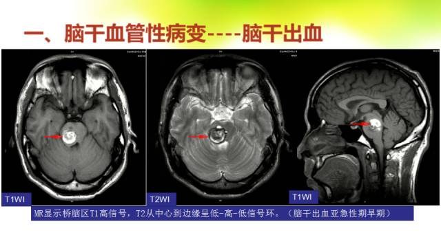 【PPT】脑干影像解剖及诊断
