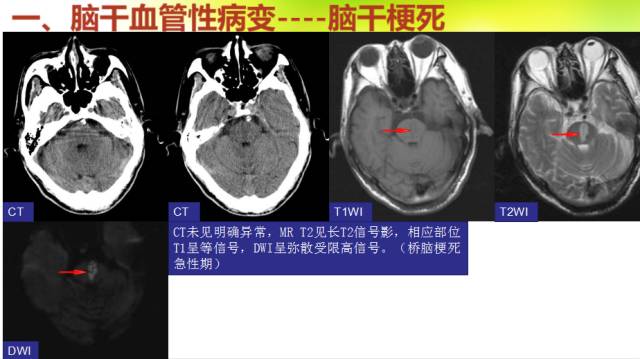 【PPT】脑干影像解剖及诊断