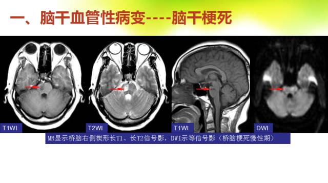 【PPT】脑干影像解剖及诊断