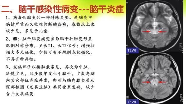 【PPT】脑干影像解剖及诊断