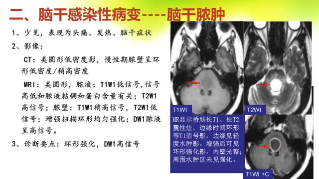 【PPT】脑干影像解剖及诊断
