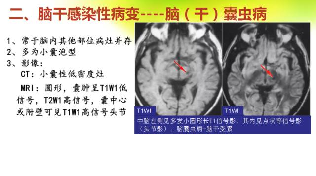 【PPT】脑干影像解剖及诊断