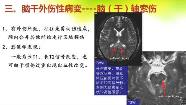 【PPT】脑干影像解剖及诊断