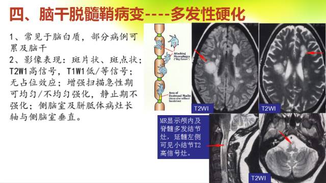 【PPT】脑干影像解剖及诊断