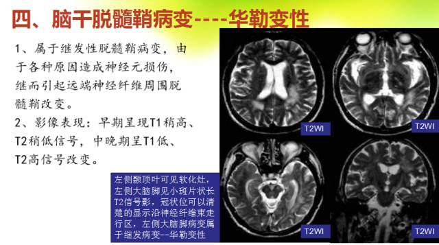 【PPT】脑干影像解剖及诊断