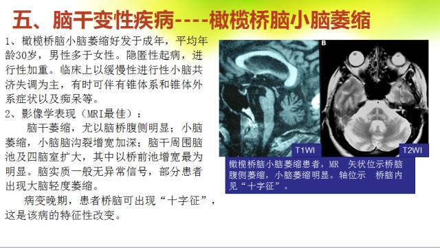 【PPT】脑干影像解剖及诊断