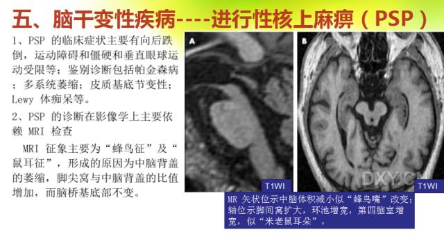 【PPT】脑干影像解剖及诊断