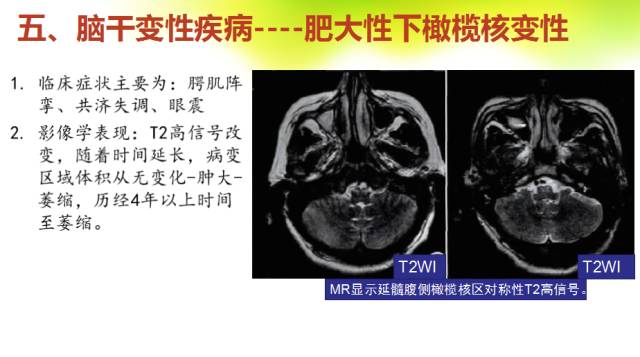 【PPT】脑干影像解剖及诊断
