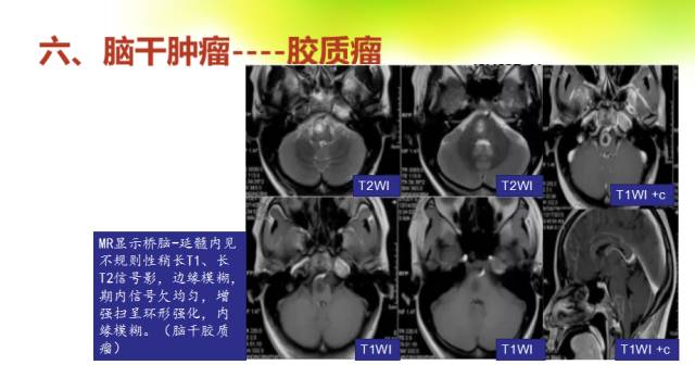 【PPT】脑干影像解剖及诊断