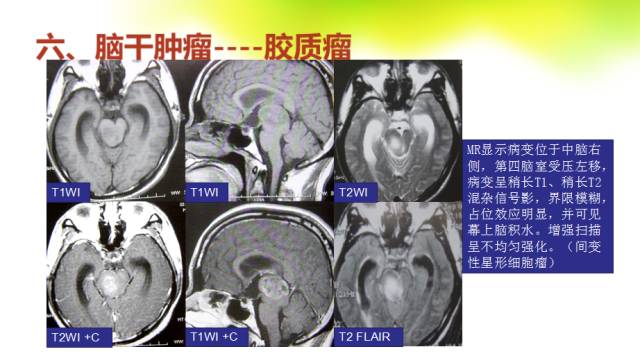【PPT】脑干影像解剖及诊断