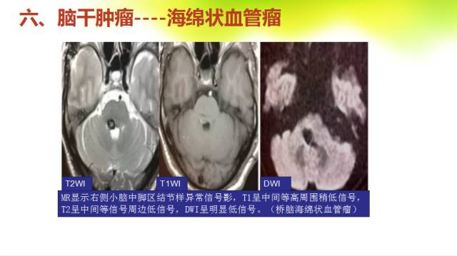 【PPT】脑干影像解剖及诊断