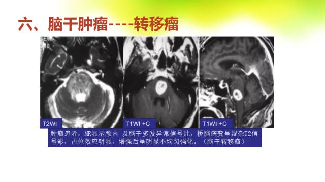 【PPT】脑干影像解剖及诊断