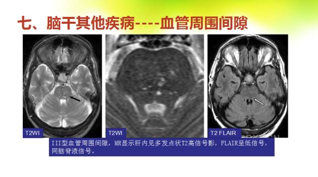 【PPT】脑干影像解剖及诊断