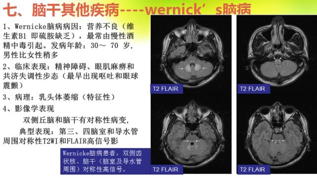 【PPT】脑干影像解剖及诊断
