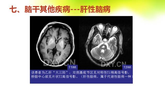 【PPT】脑干影像解剖及诊断