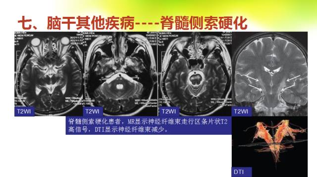 【PPT】脑干影像解剖及诊断