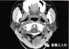 【病例】颈部神经鞘瘤1例CT影像表现 【病例】颈部神经鞘瘤1例CT影像表现