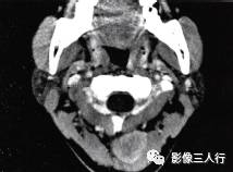【病例】颈部神经鞘瘤1例CT影像表现 【病例】颈部神经鞘瘤1例CT影像表现