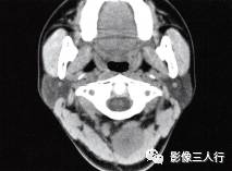 【病例】颈部神经鞘瘤1例CT影像表现 【病例】颈部神经鞘瘤1例CT影像表现