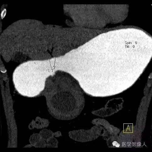 【病例】胃周肿瘤血管成像 【病例】胃周肿瘤血管成像