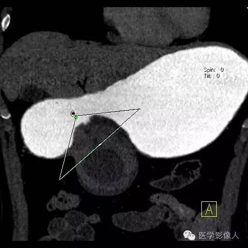 【病例】胃周肿瘤血管成像 【病例】胃周肿瘤血管成像