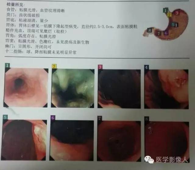 【病例】胃周肿瘤血管成像 【病例】胃周肿瘤血管成像