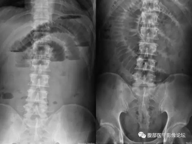 【病例】回肠淋巴瘤并肠套叠1例CT 【病例】回肠淋巴瘤并肠套叠1例CT