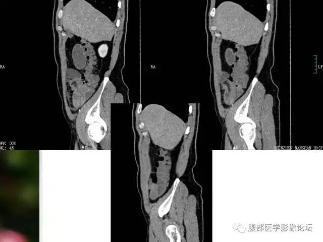 【病例】回肠淋巴瘤并肠套叠1例CT 【病例】回肠淋巴瘤并肠套叠1例CT