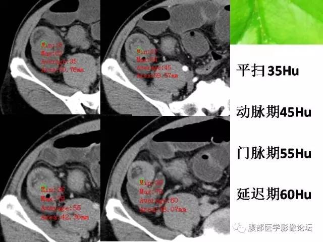 【病例】回肠淋巴瘤并肠套叠1例CT 【病例】回肠淋巴瘤并肠套叠1例CT
