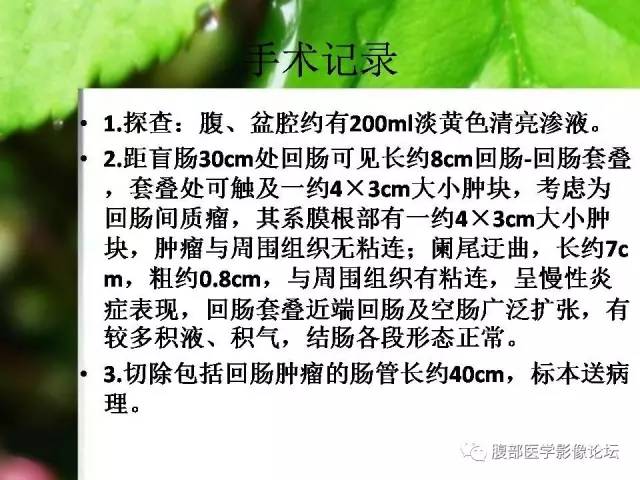 【病例】回肠淋巴瘤并肠套叠1例CT 【病例】回肠淋巴瘤并肠套叠1例CT