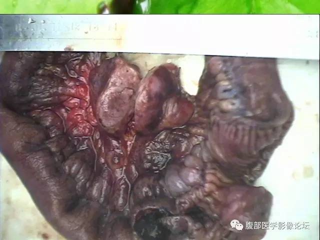 【病例】回肠淋巴瘤并肠套叠1例CT 【病例】回肠淋巴瘤并肠套叠1例CT