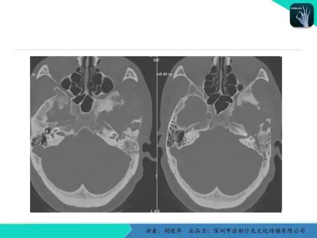 【PPT】颅面骨巨细胞修复性肉芽肿的影像诊断