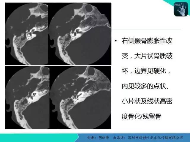 【PPT】颅面骨巨细胞修复性肉芽肿的影像诊断