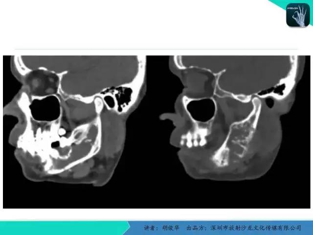 【PPT】颅面骨巨细胞修复性肉芽肿的影像诊断