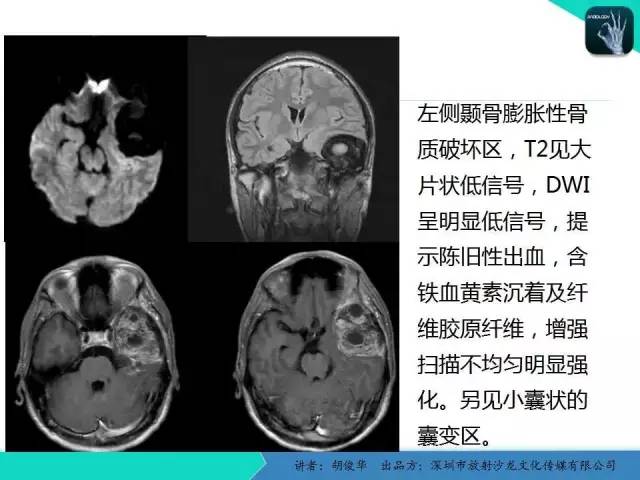 【PPT】颅面骨巨细胞修复性肉芽肿的影像诊断