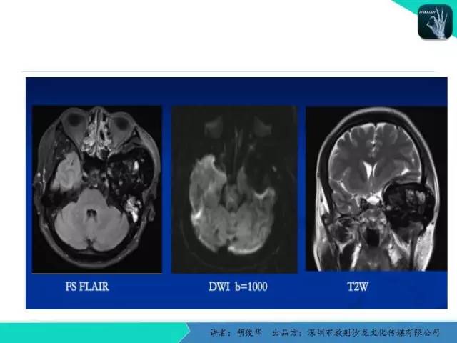 【PPT】颅面骨巨细胞修复性肉芽肿的影像诊断