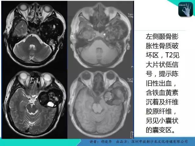 【PPT】颅面骨巨细胞修复性肉芽肿的影像诊断