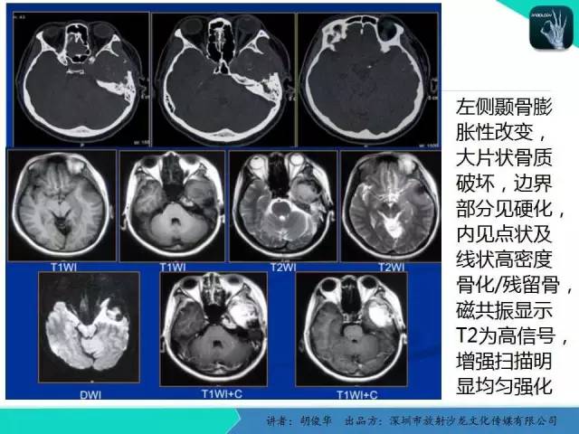 【PPT】颅面骨巨细胞修复性肉芽肿的影像诊断